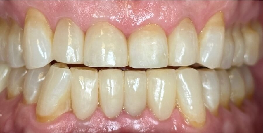 Bioclear 1 After
