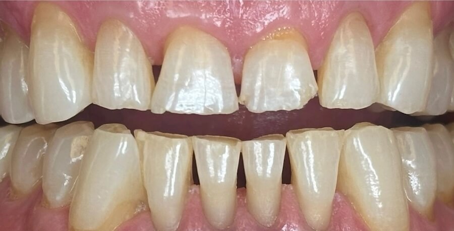 Bioclear 1 BEfore