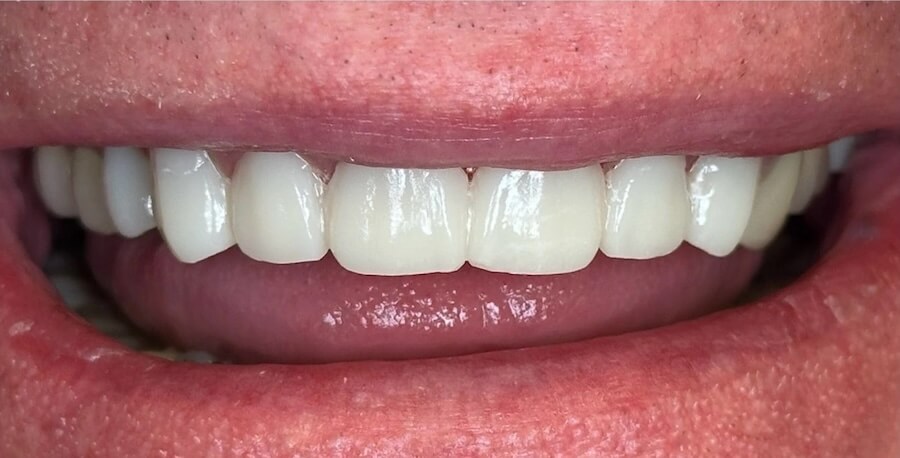 Crowns 1 After