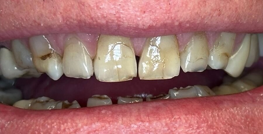 Crowns 1 Before