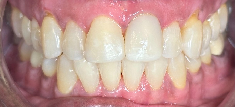 Smile makeover after