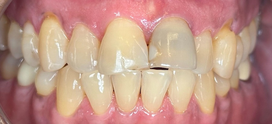 Smile makeover before
