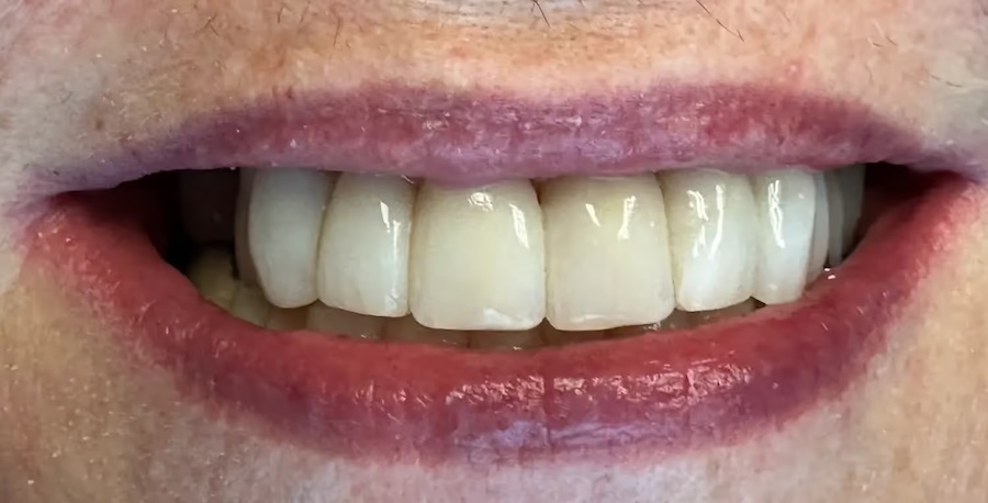 Bioclear after