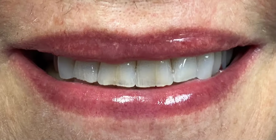 Bioclear Before