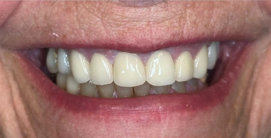 Crowns after