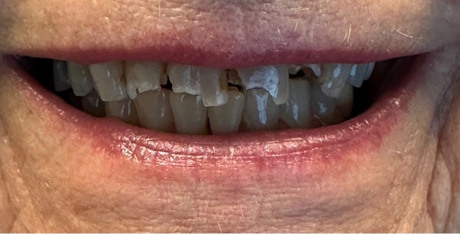 Crowns after