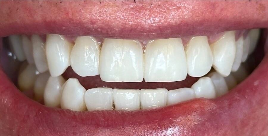 Whitening after