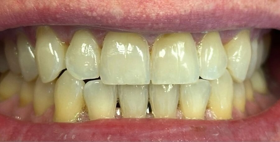Whitening before