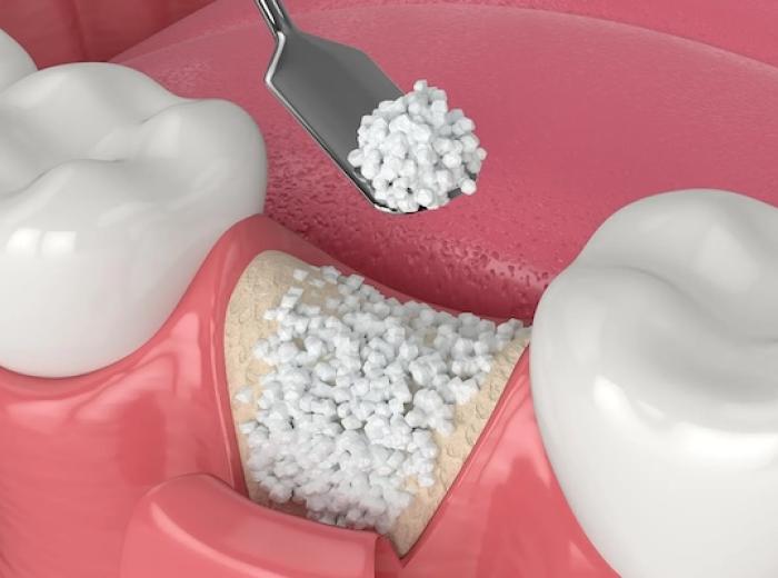 Bone Grafts: Essential Prep for Secure Implants in Skokie