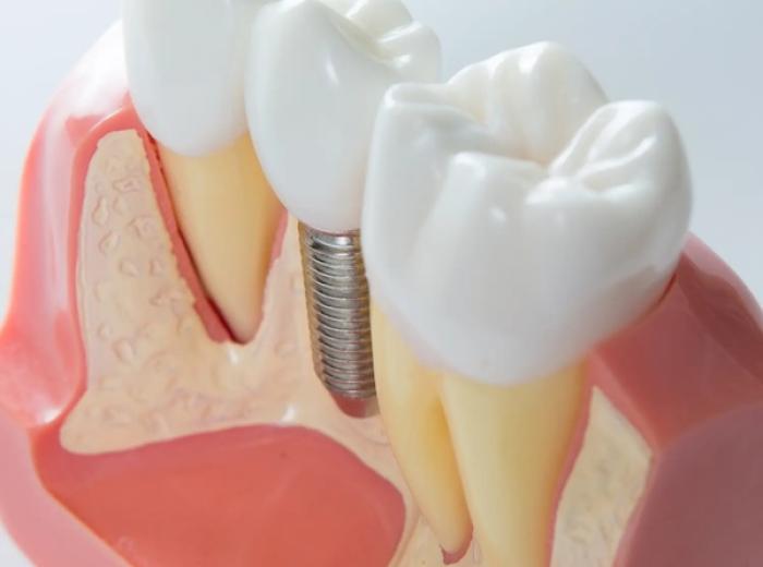 Single Implant vs. Bridge: The Permanent Tooth Solution for a Healthy, Confident Smile